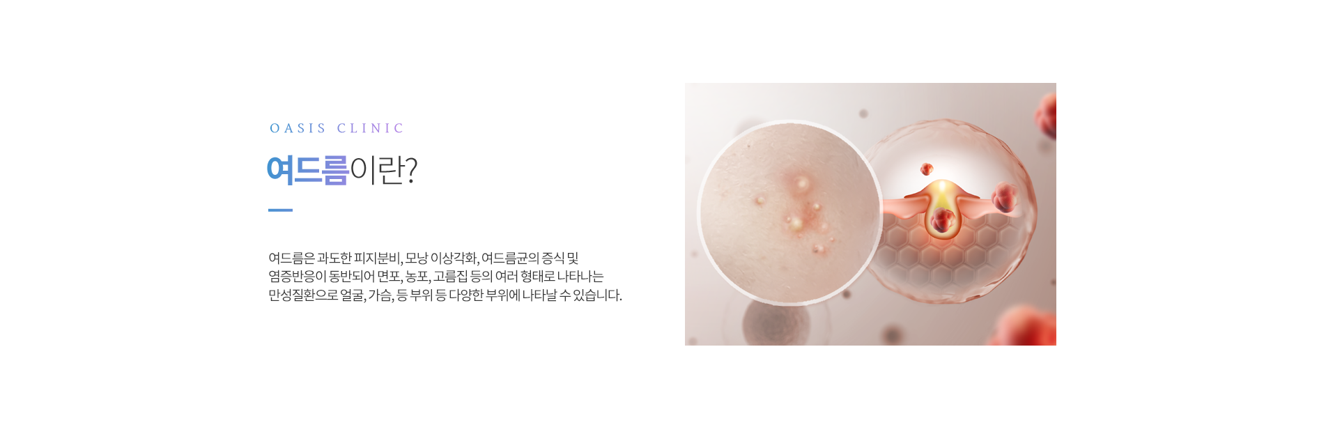 여드름·여드름흉터란?