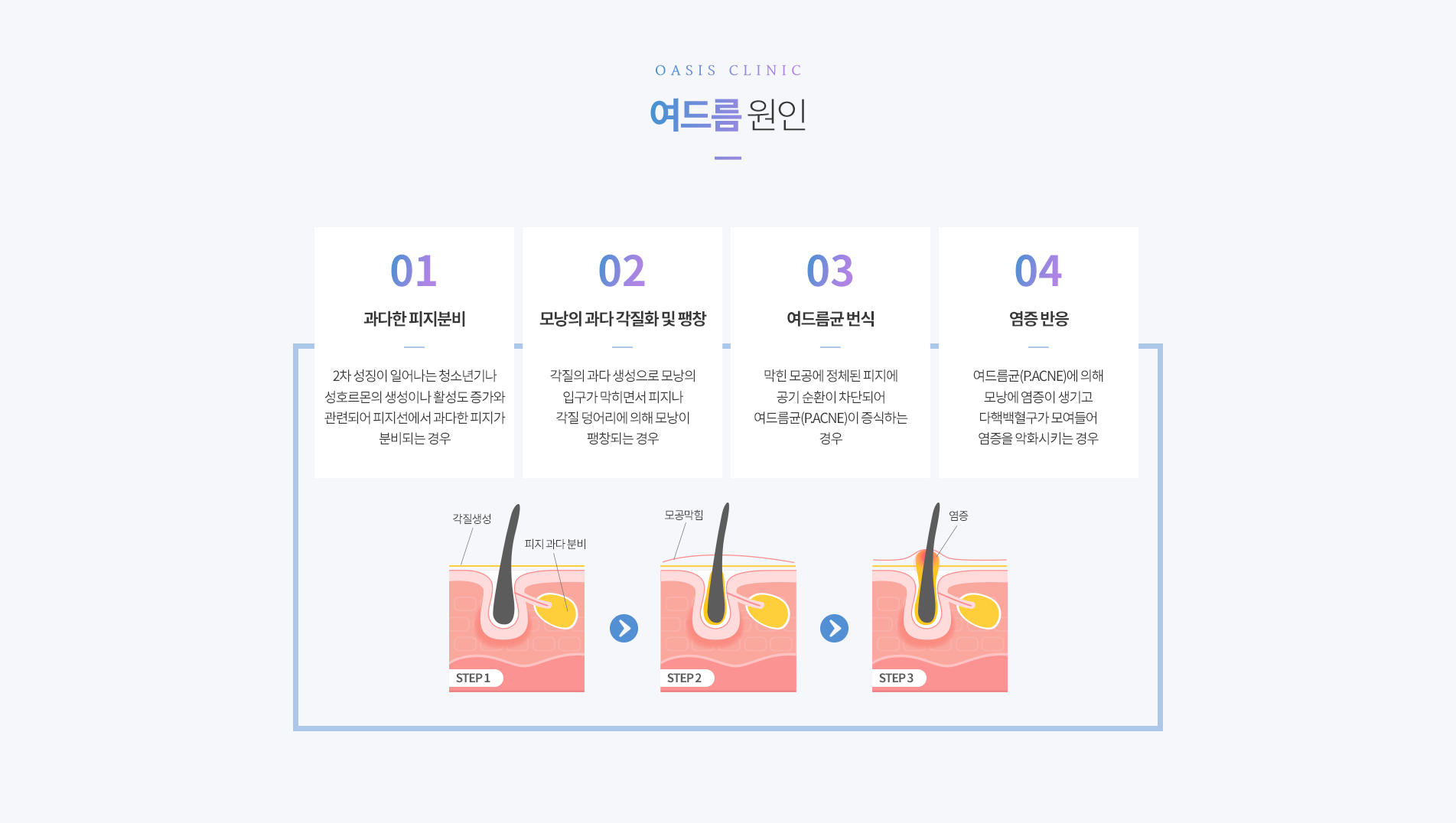 여드름 원인