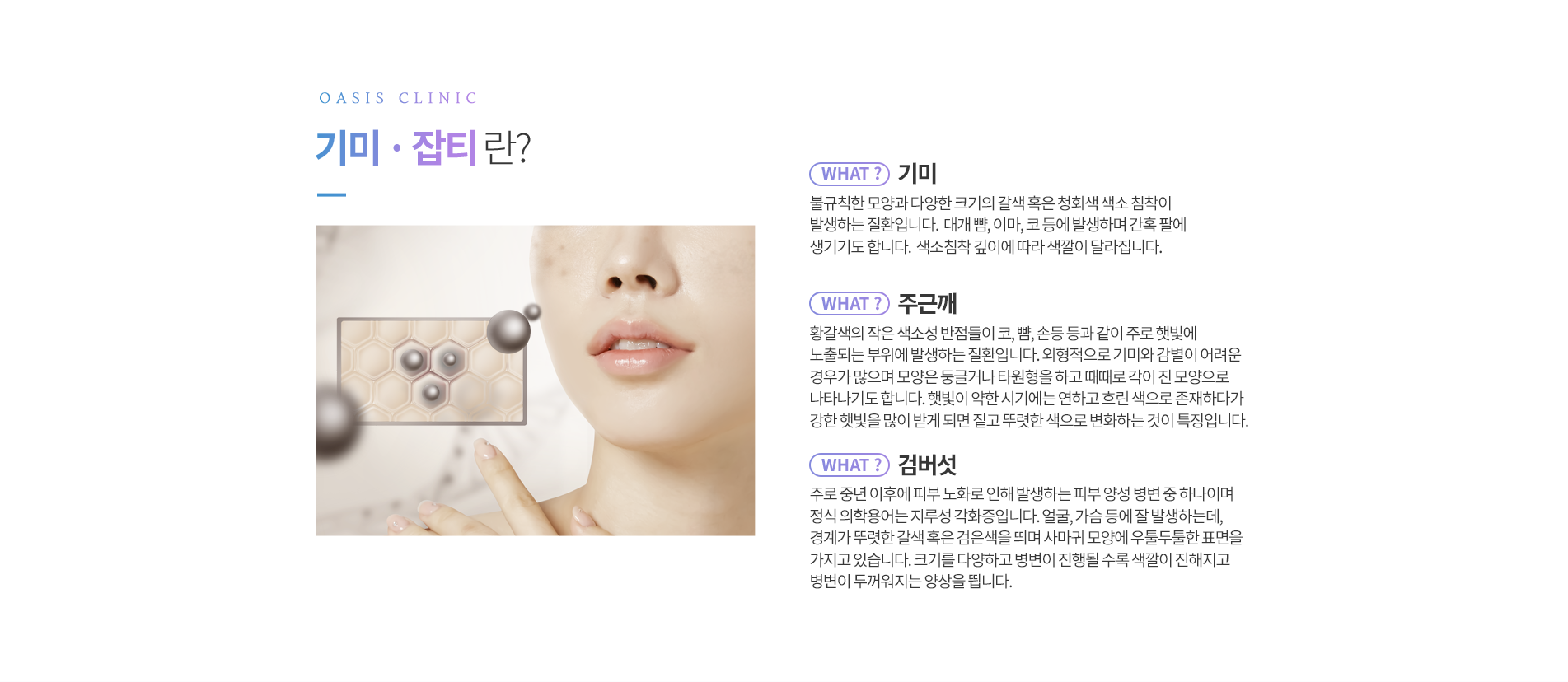 기미·잡티란?