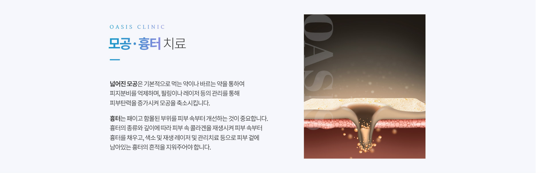모공흉터 치료