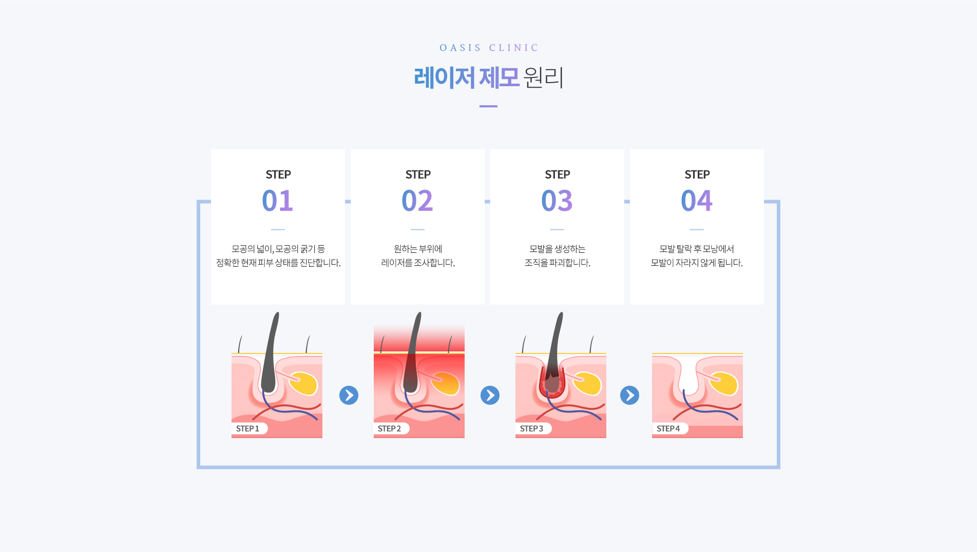 레이저제모 원리